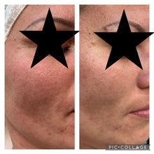 Load image into Gallery viewer, Vagheggi Balance Acne Treatment Kit