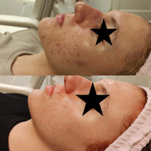 Load image into Gallery viewer, Vagheggi Balance Acne Treatment Kit
