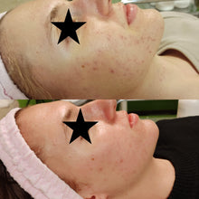 Load image into Gallery viewer, Vagheggi Balance Acne Treatment Kit
