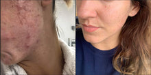 Load image into Gallery viewer, Vagheggi Balance Acne Treatment Kit
